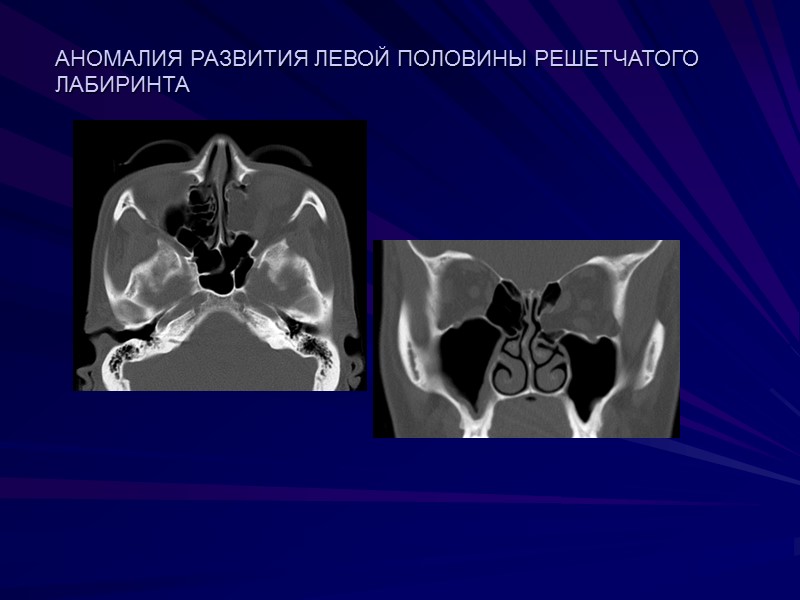 АНОМАЛИЯ РАЗВИТИЯ ЛЕВОЙ ПОЛОВИНЫ РЕШЕТЧАТОГО ЛАБИРИНТА